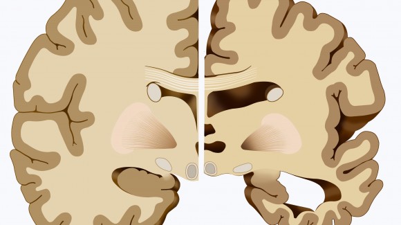 Alzheimer : la régulation du peptide Aβ dans le cerveau malade