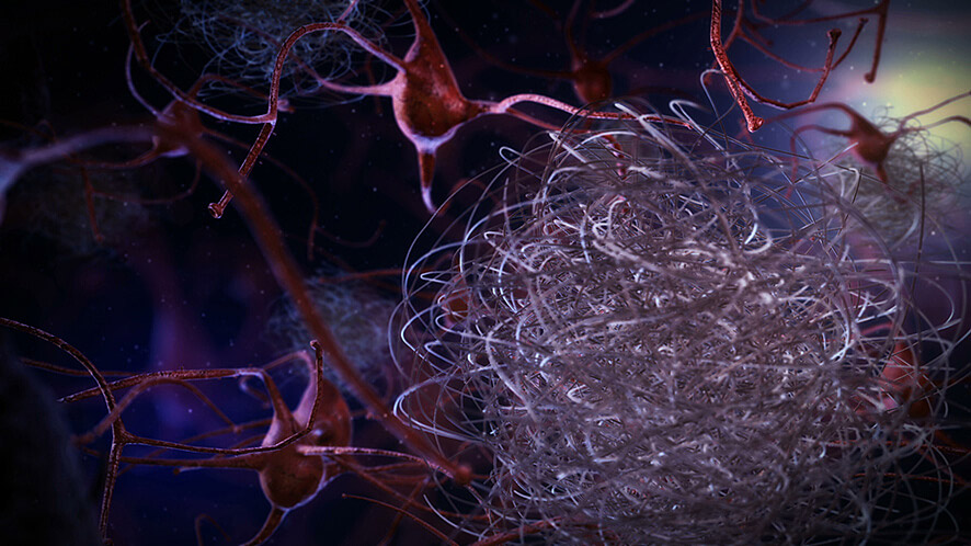 Définition Alzheimer - Neurones et plaques amyloïdes